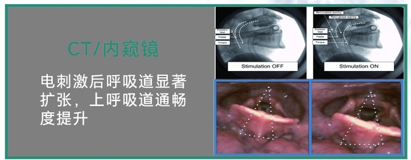 CT/内窥镜证据